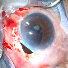 Iris Prolapse example