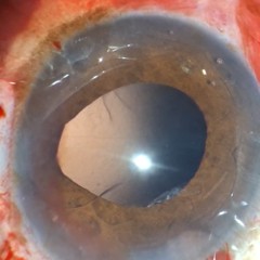 Vitreous Loss example